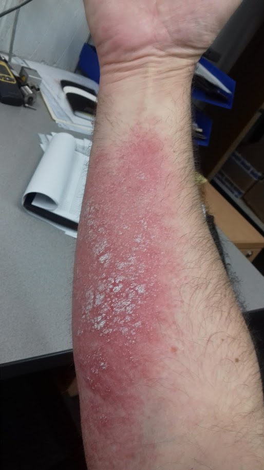 eczema on my arm